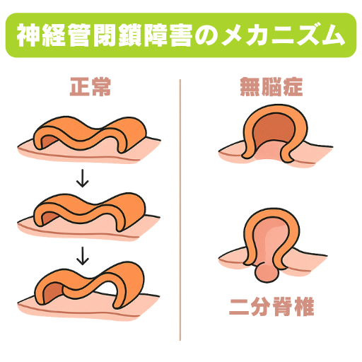 「神経管閉鎖障害のメカニズムを示した図解」