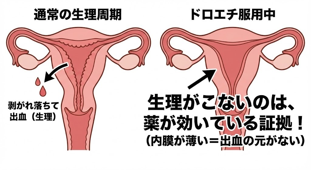 通常の生理周期とドロエチ服用中の子宮内膜の状態を比較した断面図。ドロエチ服用中は子宮内膜が薄くなるため出血の元がなくなり、生理がこない（＝薬が効いている証拠）ことを説明する図解。