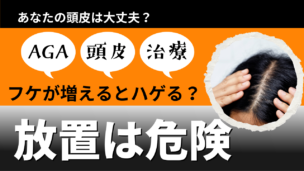 AGAでフケが増える理由とは？原因・治療法・正しい頭皮ケアを徹底解説！